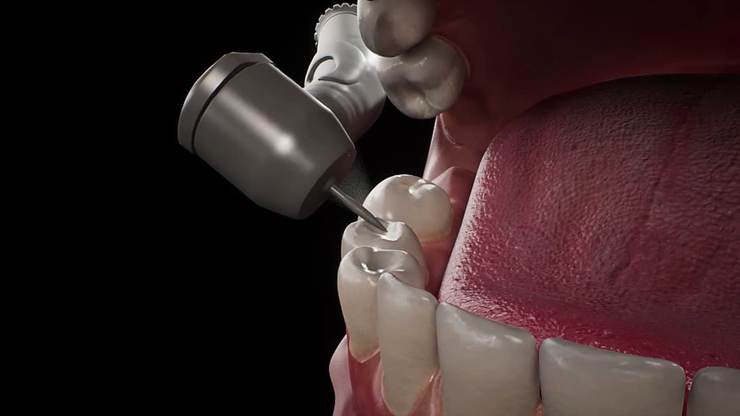 The handpiece preparing a lower molar